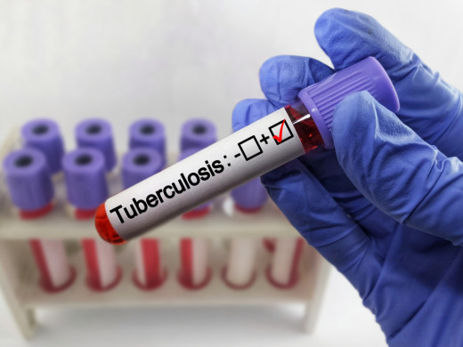 Tuberkulóza se Česka drží