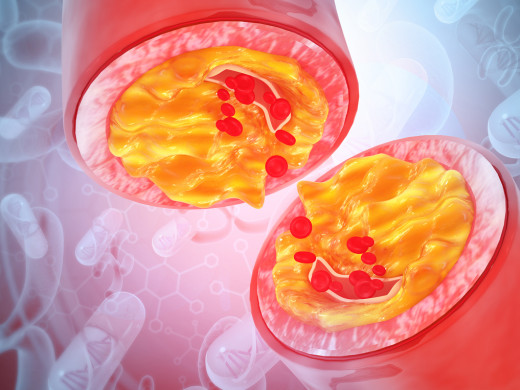 Adherence a hypercholesterolémie